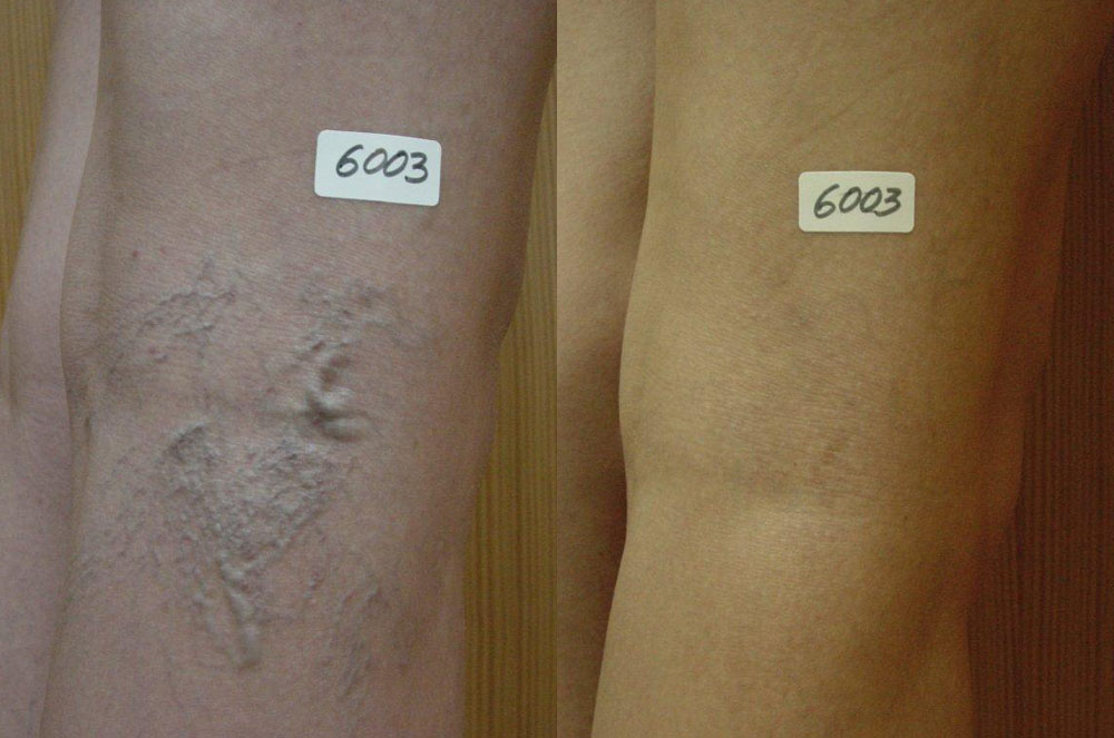 Tractament de varius efectuar pel doctor Carlos Boné