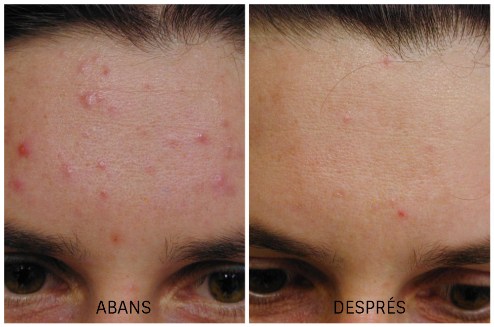 Abans i després: Tractament d'acnè - Dermandtek