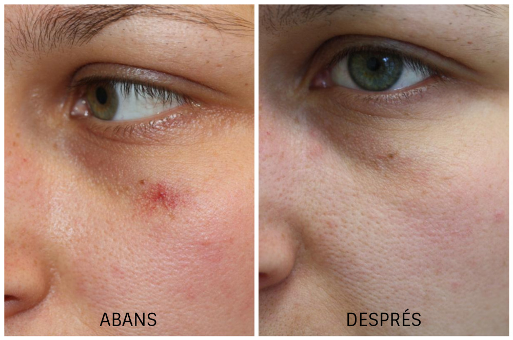 Abans i després: Tractament de taques a la pell Dermandtek
