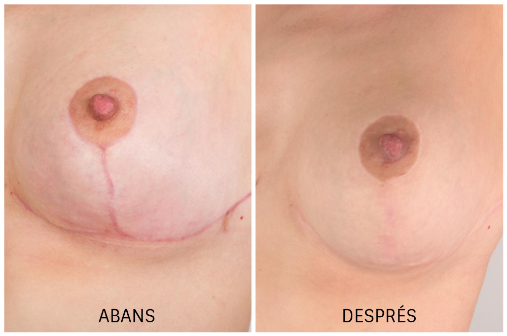 Abans i després: reducció de pit a Dermandtek
