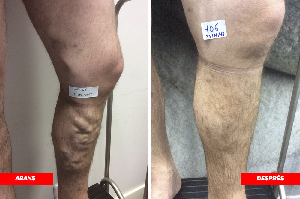 Resultats d'un pacient de Carlos Boné