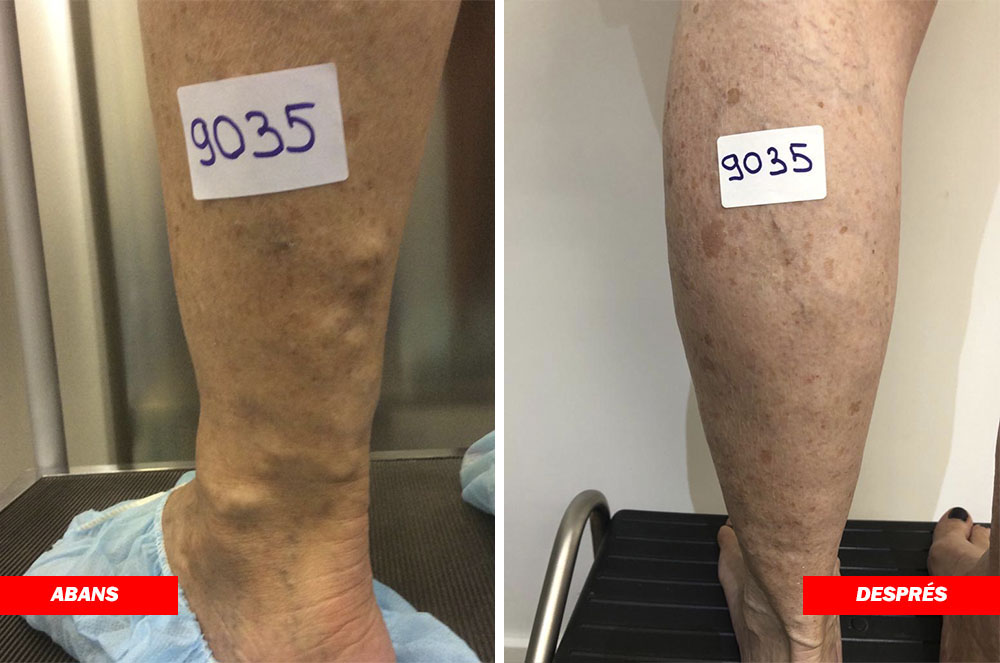 Resultats d'un pacient del doctor Carlos Boné