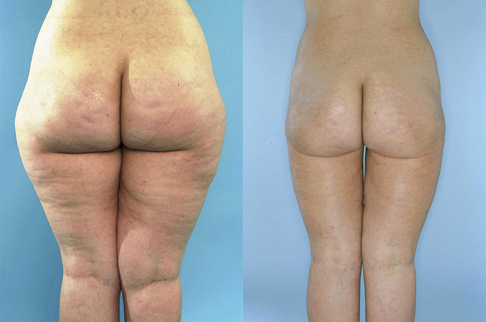 Abans i després de les cames