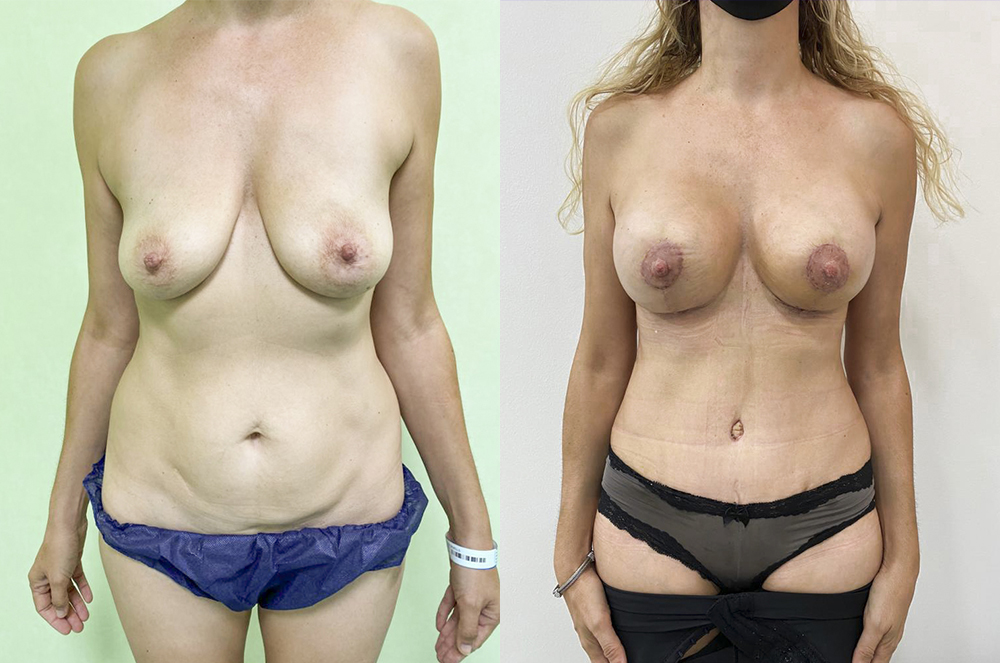 Abans i despres mommy makeover