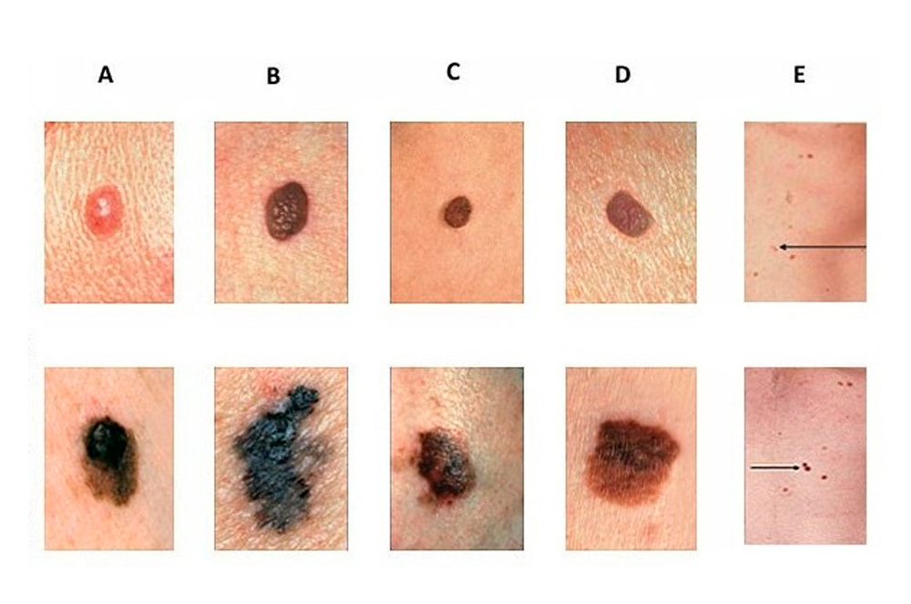 L’ABCDE del melanoma