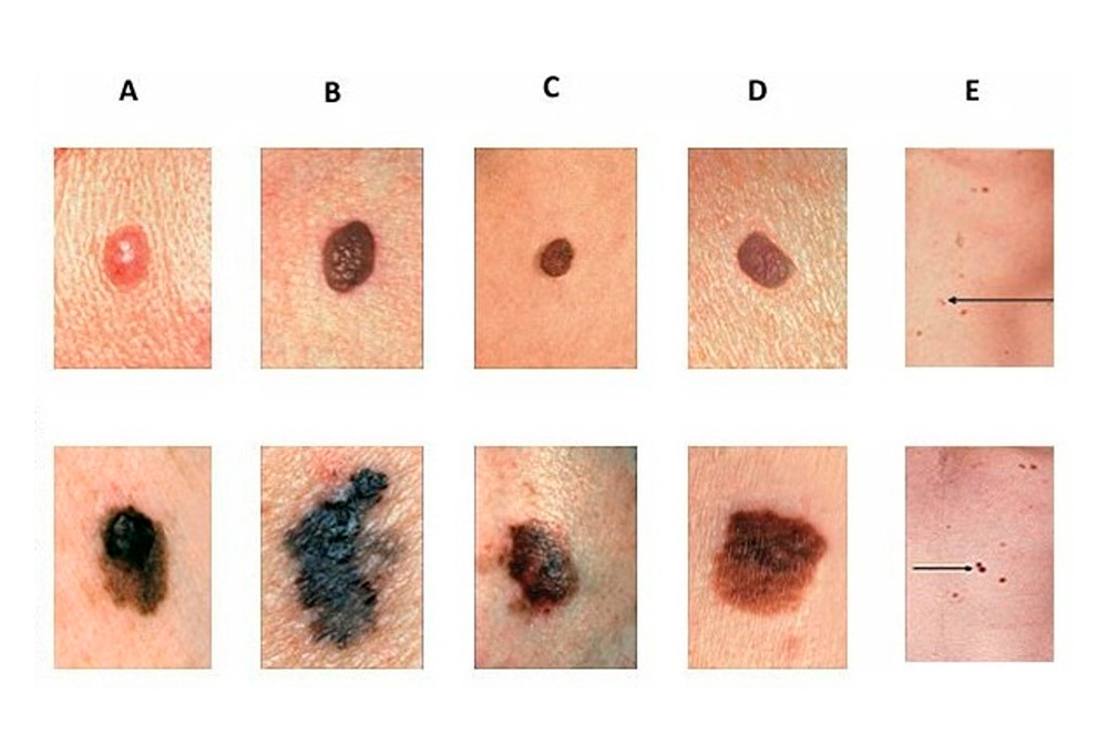 L’ABCDE del melanoma